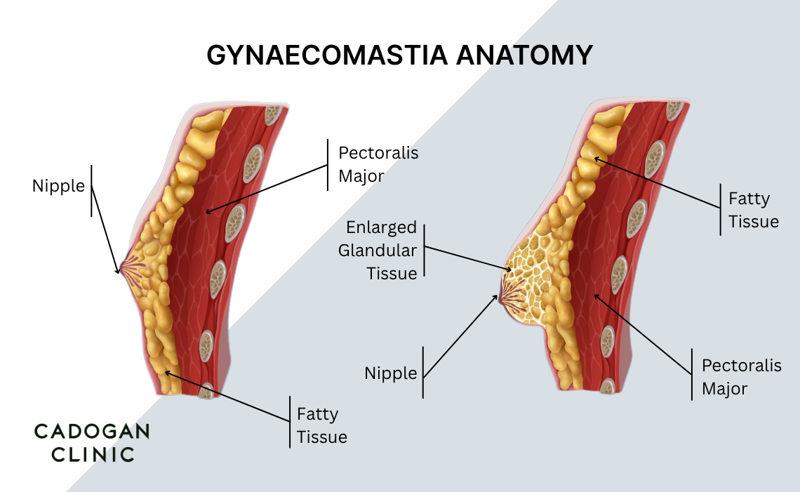 Diagram showing the anatomy of Gynaecomastia compared with typical internal chest development in men
